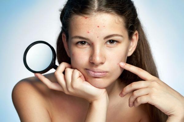 I Don’t Have Acne, I Just Have “Complexion Problems”