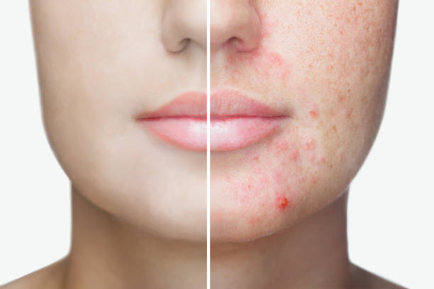 Does Dirty Skin Causes Acne?