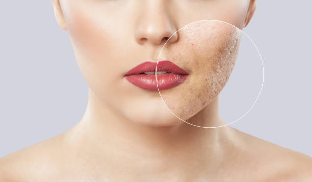Who Gets Cosmetic Acne?