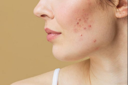 How to Stop Period Breakouts Before They Start