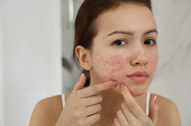 What is Skin Purging?