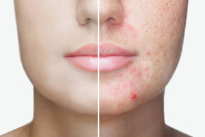 Does Dirty Skin Causes Acne?