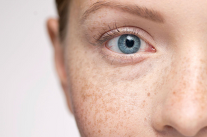 Everything You Need to Know About Hyperpigmentation