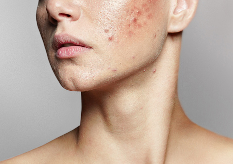 How Long Does Skin Purging Last?