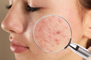 How to help preempt those pesky pimples