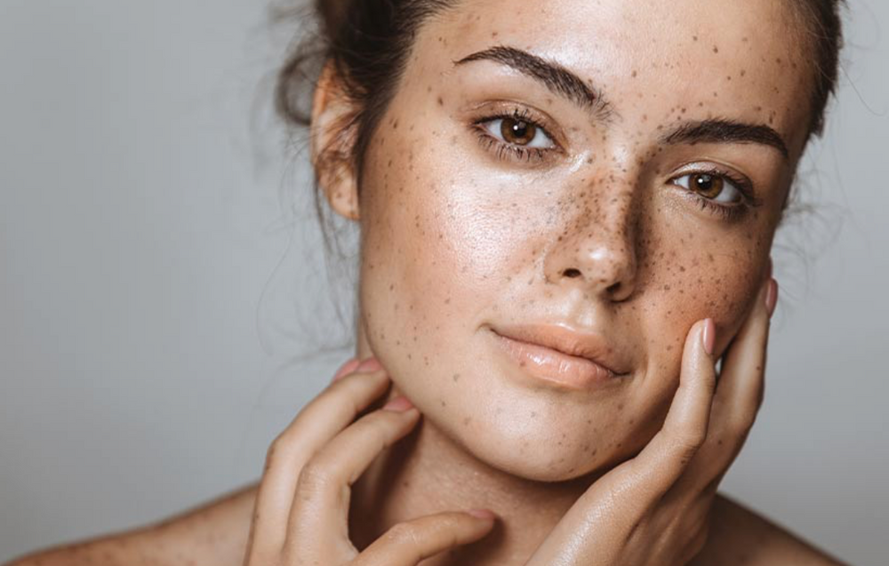 Hyperpigmentation: What You Need to Know - Vasseur Skincare