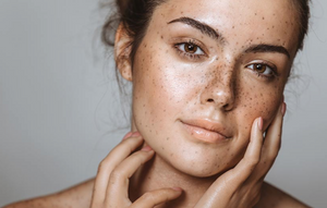 Hyperpigmentation: What You Need to Know