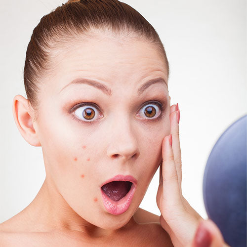 The Not-So-Lovely Return of Monthly Hormonal Acne