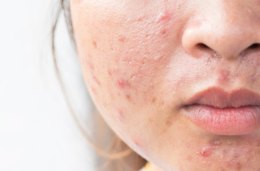 Purging Your Skin for a Fresh New Look