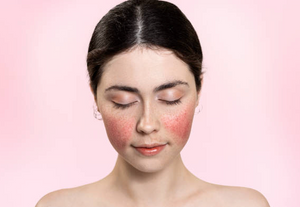 Rosacea - The Culprits that Trigger and Cause it