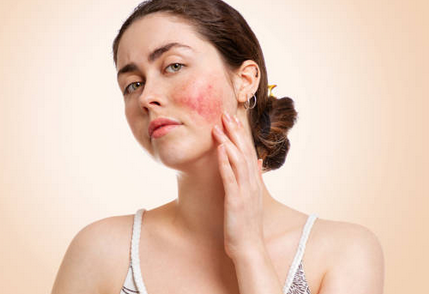 5 Foods to Avoid If You Have Rosacea