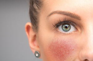 Rosacea: Causes to Avoid and Ways to Combat It