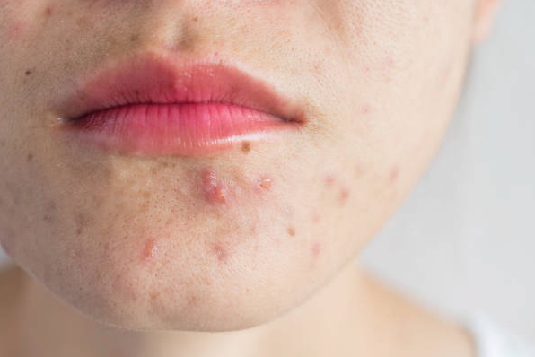 Spring into Acne Solutions