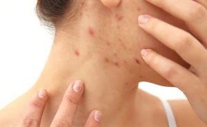 The Silent Culprits: 5 Causes of Acne to Avoid