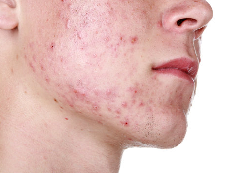 Is Your Skin Purging or Reacting? How to Tell the Difference